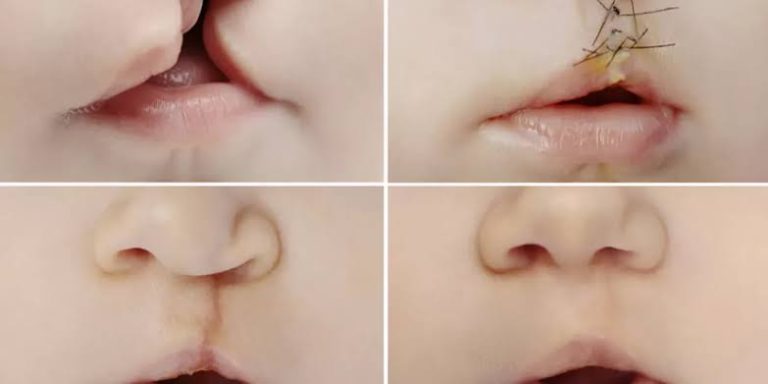 افضل علاج للشفة الارنبية