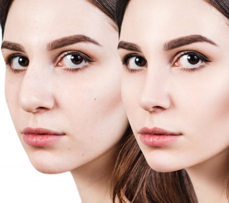 عمليات تجميل الانف العريض والمزيا وآليات التجميل