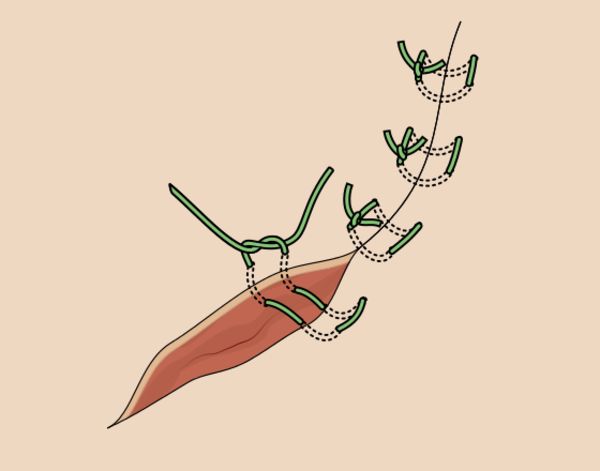 الفرق بين الخياطة التجميلية والعادية