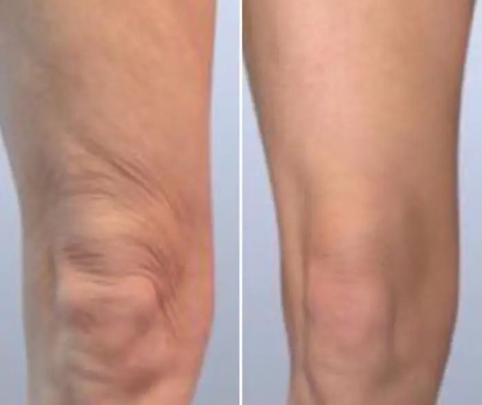 أسباب ترهلات الفخذين