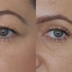 علاج سقوط جفن العين: الدليل الشامل لعملية تجميل الجفون (Blepharoplasty)