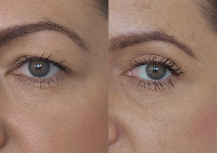علاج سقوط جفن العين: الدليل الشامل لعملية تجميل الجفون (Blepharoplasty)