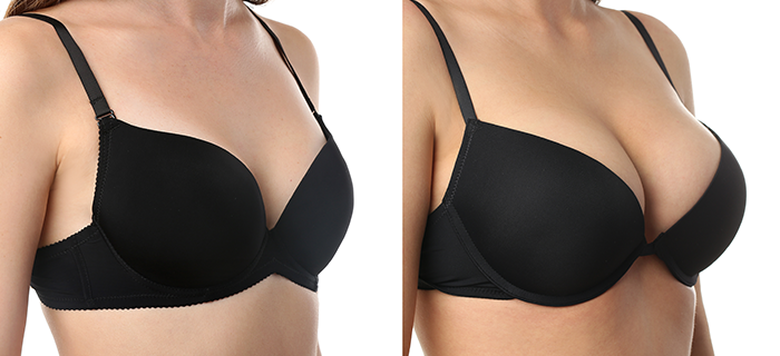 عمليات شد الثدي