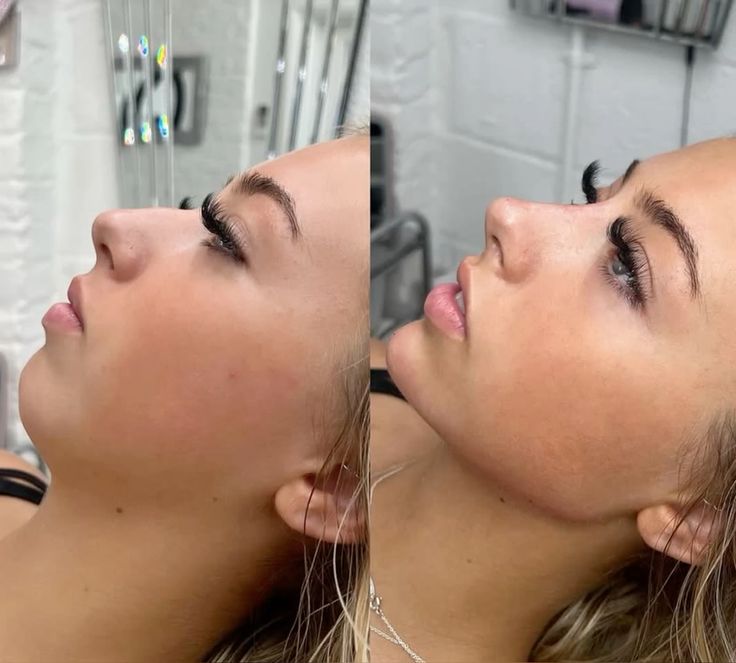 مراحل تغير الانف بعد عملية التجميل​ بالتفصيل 