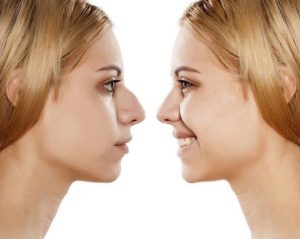 أفضل دكتور تجميل أنف في مصر – د. علي الشافعي