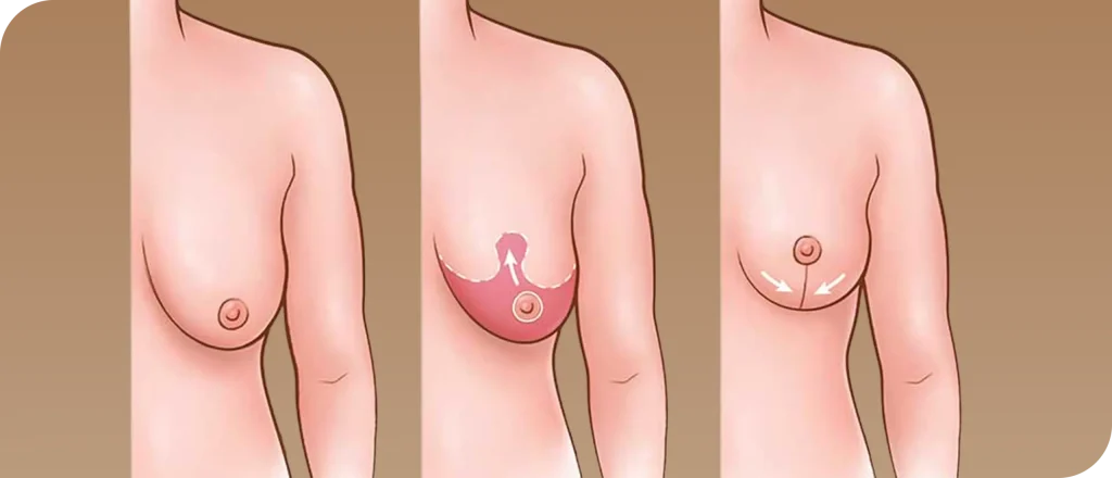 عمليات شد الثدي