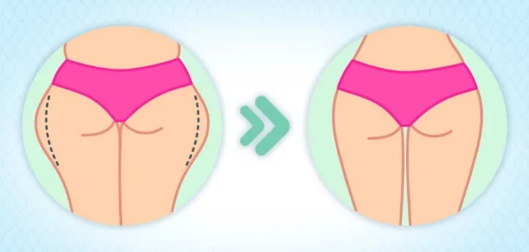 نحت الخصر وتكبير الأرداف لتحقيق القوام المثالي