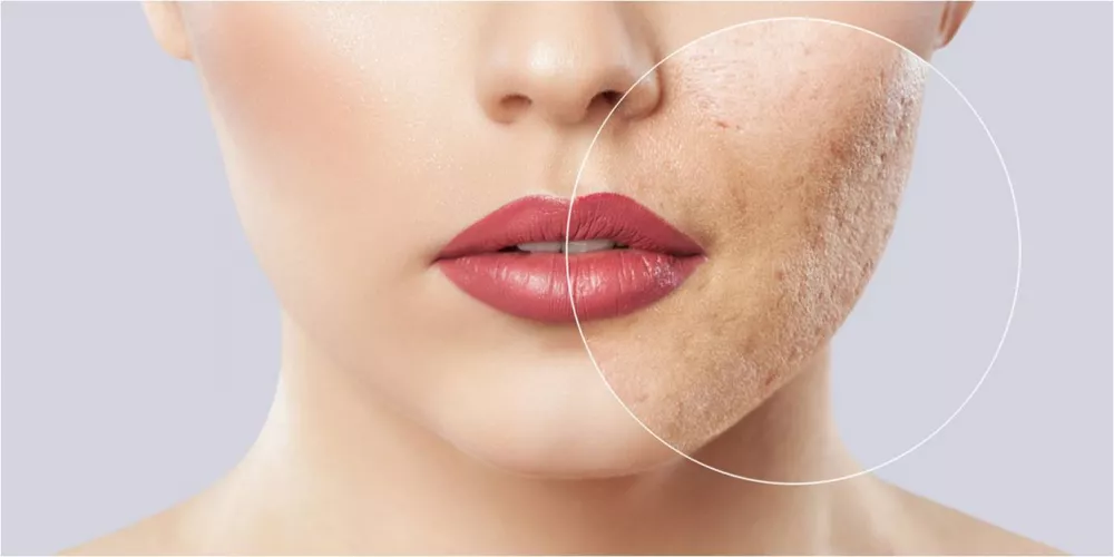 تجميل الوجه من آثار حب الشباب