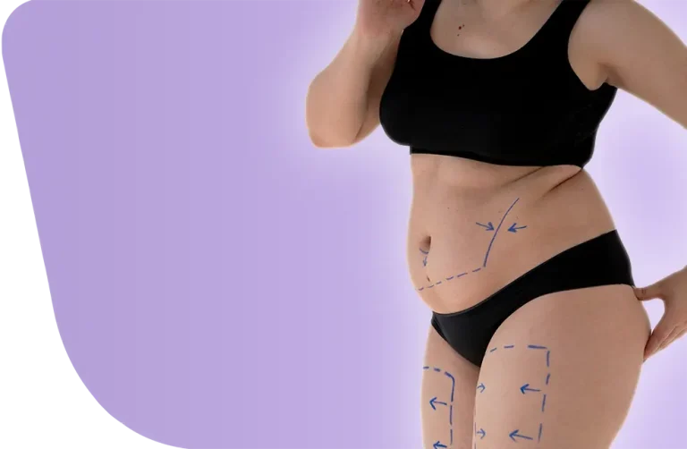 وداعًا للبطن المترهل: ما سبب اللجوء لعملية شفط دهون البطن