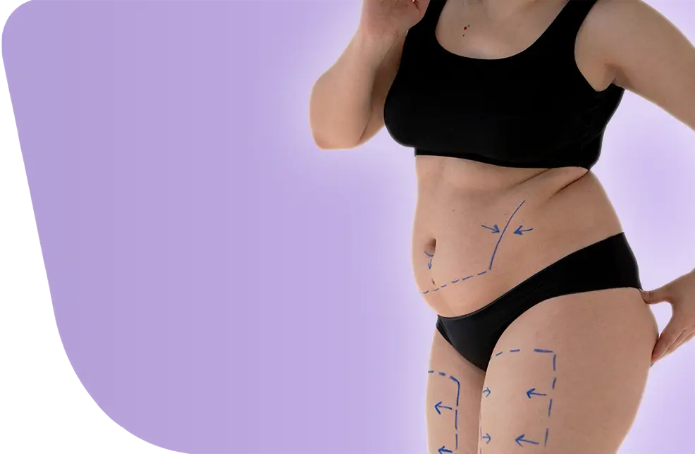 شفط الدهون بالفيزر