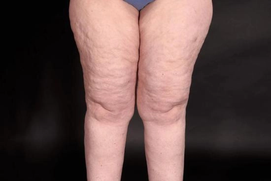 الوذمة الشحمية أو الليبيديما