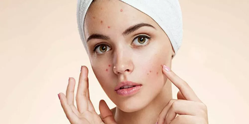 تجميل الوجه من آثار حب الشباب