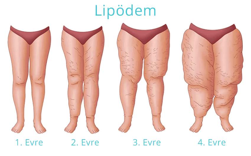 الوذمة الشحمية أو الليبيديما