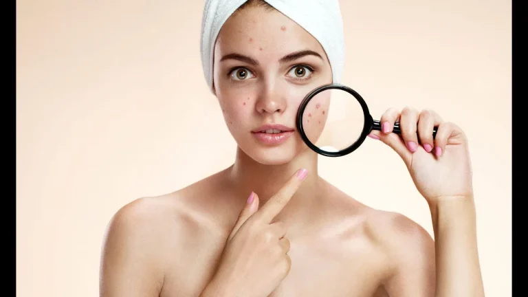 تجميل الوجه من آثار حبّ الشباب