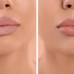 توريد الشفاه: الدليل الطبي المتكامل لاستعادة لون الشفاه الطبيعي والجذاب