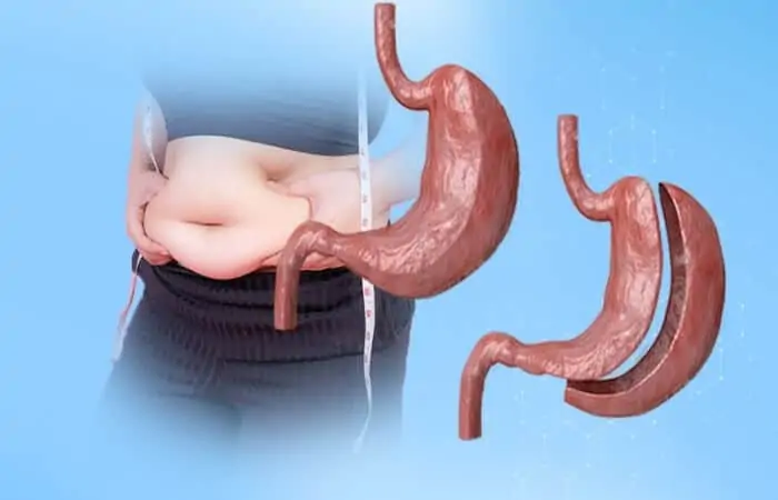 الفرق بين عملية تدبيس المعدة وتكميم المعدة