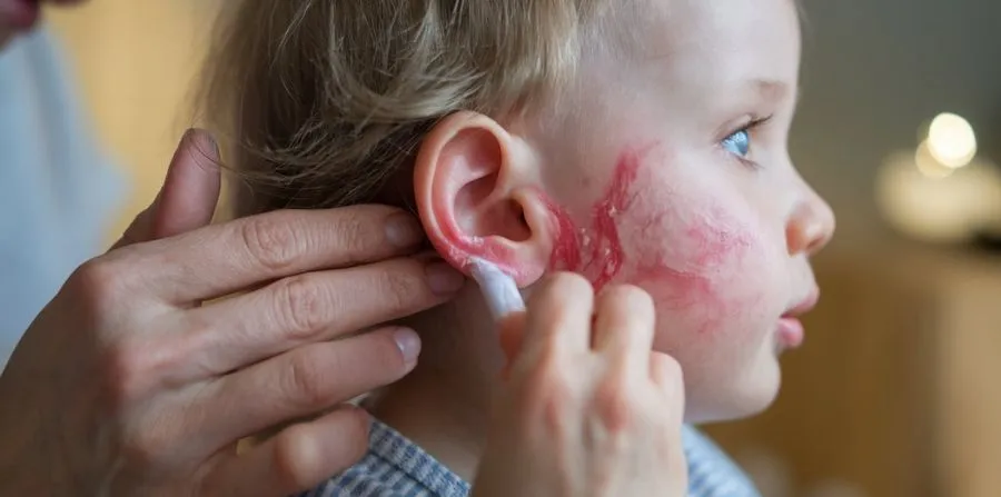 الصدفية عند الأطفال بالصور