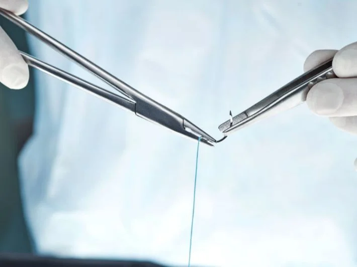 متى تسقط خيوط الخياطة التجميلية