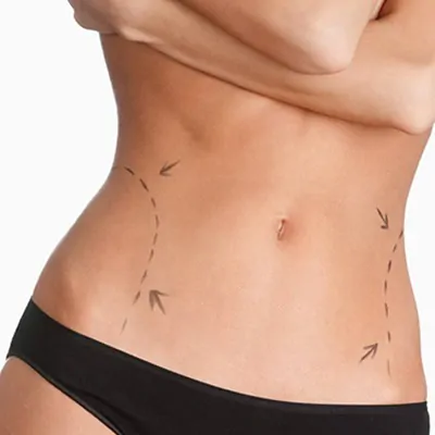 نحت الجسم بالتبريد