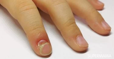 الصدفية عند الأطفال بالصور