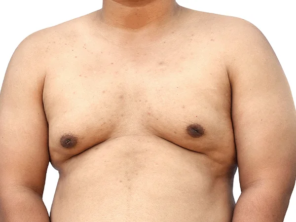 التثدى عند الرجال